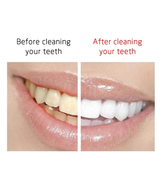 Ultrasonic Plaque & Tartar Dental Set